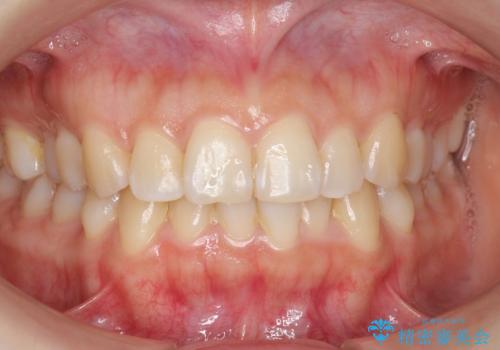 下の前歯のがたつき インビザラインでの治療前