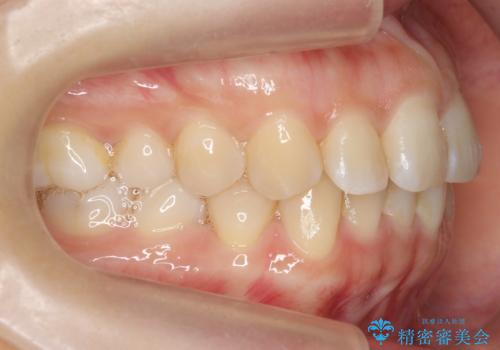 下の前歯のがたつき インビザラインでの治療前