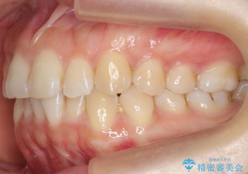 下の前歯のがたつき インビザラインでの治療前