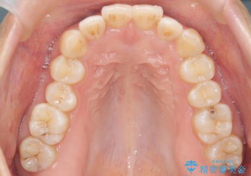 下の前歯のがたつき インビザラインでの治療前
