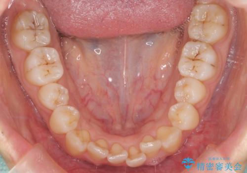 下の前歯のがたつき　インビザラインでの症例 治療前