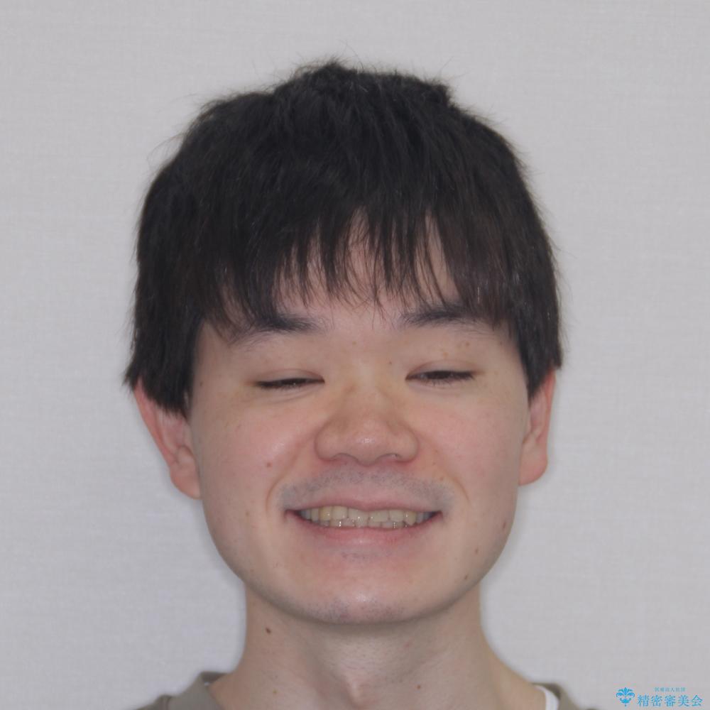 【モニター】前歯のデコボコとクロスバイト ワイヤー矯正で短期間に仕上げるの治療後(顔貌)