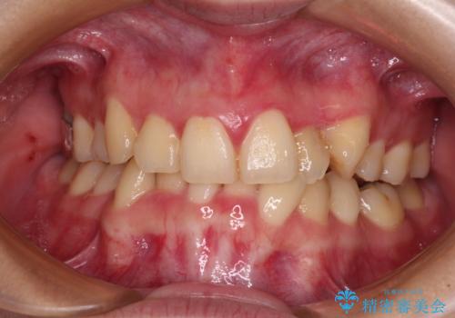 【モニター】再矯正でデコボコの前歯を改善　抜歯矯正の後戻りの症例 治療前