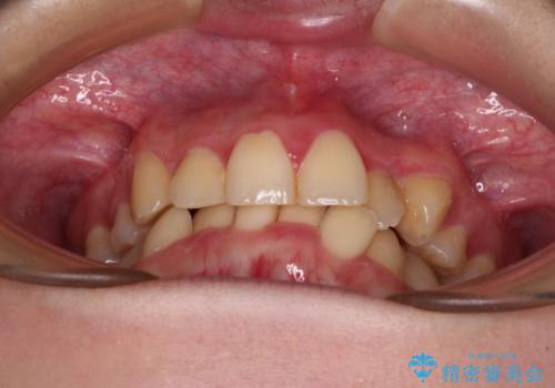 【モニター】再矯正でデコボコの前歯を改善　抜歯矯正の後戻りの治療前