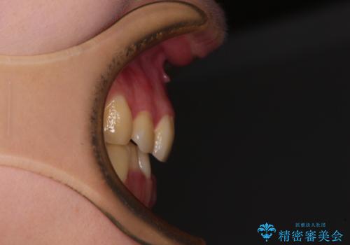 【モニター】再矯正でデコボコの前歯を改善 抜歯矯正の後戻りの治療前