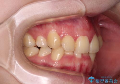 【モニター】再矯正でデコボコの前歯を改善 抜歯矯正の後戻りの治療前