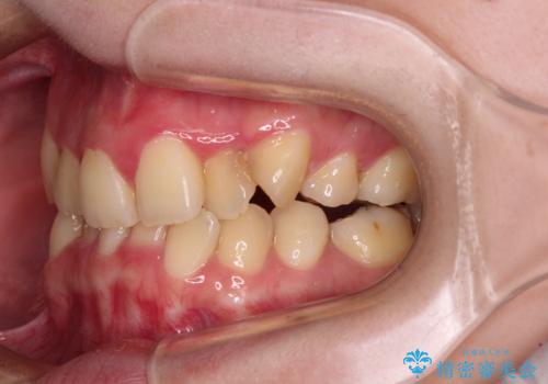 【モニター】再矯正でデコボコの前歯を改善 抜歯矯正の後戻りの治療前