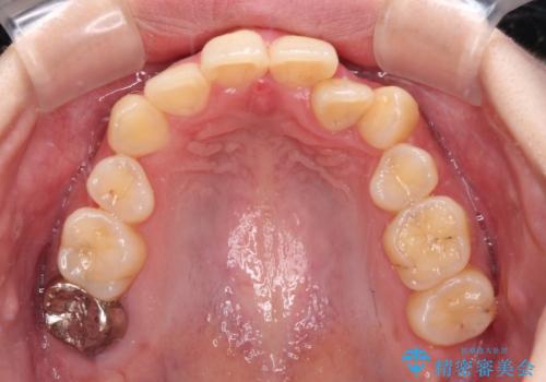 【モニター】再矯正でデコボコの前歯を改善 抜歯矯正の後戻りの治療前