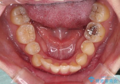 【モニター】再矯正でデコボコの前歯を改善 抜歯矯正の後戻りの治療前
