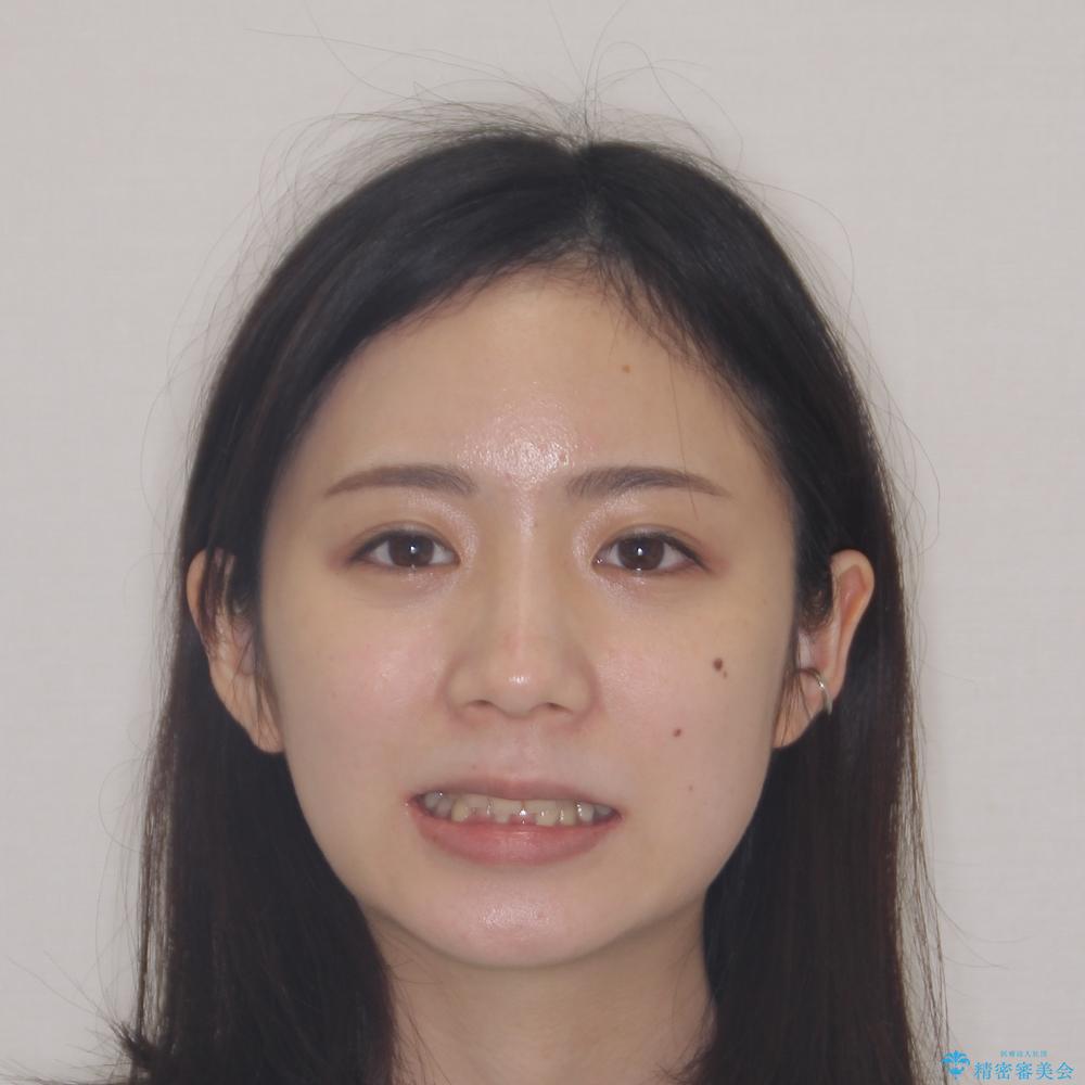 【モニター】再矯正でデコボコの前歯を改善 抜歯矯正の後戻りの治療前(顔貌)
