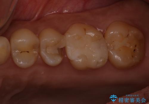 歯が欠けた セラミックインレーの症例 治療前