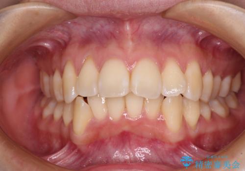 閉じにくい口元を抜歯矯正ですっきりとの症例 治療前