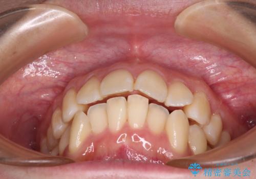 閉じにくい口元を抜歯矯正ですっきりとの治療前