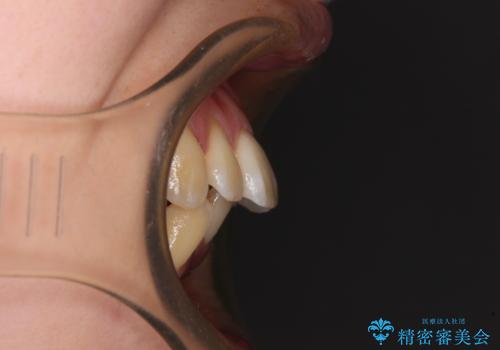 閉じにくい口元を抜歯矯正ですっきりとの治療前