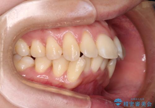閉じにくい口元を抜歯矯正ですっきりとの治療前