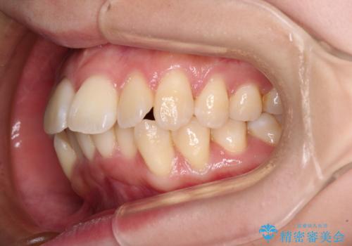 閉じにくい口元を抜歯矯正ですっきりとの治療前