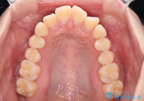 閉じにくい口元を抜歯矯正ですっきりとの治療前