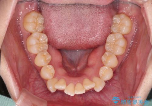 閉じにくい口元を抜歯矯正ですっきりとの治療前