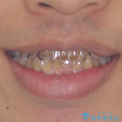 前歯のデコボコを費用を抑えたメタルブラケットできれいにの治療前(顔貌)
