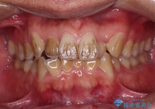 前歯のデコボコを費用を抑えたメタルブラケットできれいにの治療前