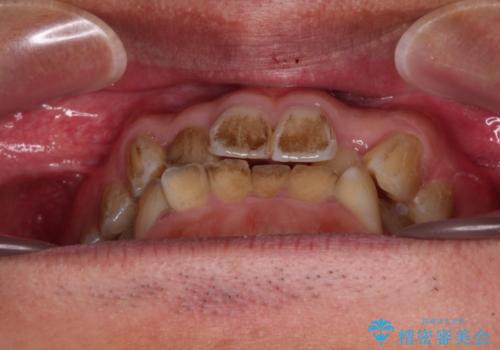 前歯のデコボコを費用を抑えたメタルブラケットできれいにの治療前