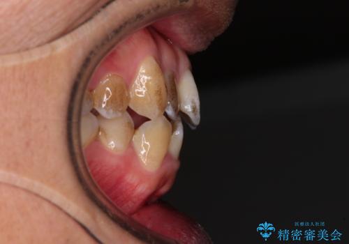 前歯のデコボコを費用を抑えたメタルブラケットできれいにの治療前