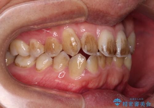 前歯のデコボコを費用を抑えたメタルブラケットできれいにの治療前