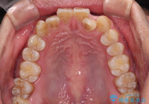 前歯のデコボコを費用を抑えたメタルブラケットできれいにの治療前