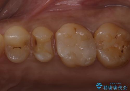 歯が欠けた セラミックインレーの治療中