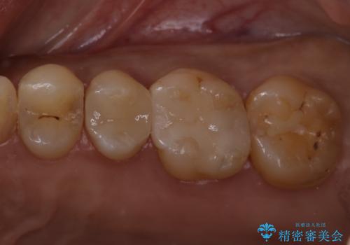 歯が欠けた セラミックインレー