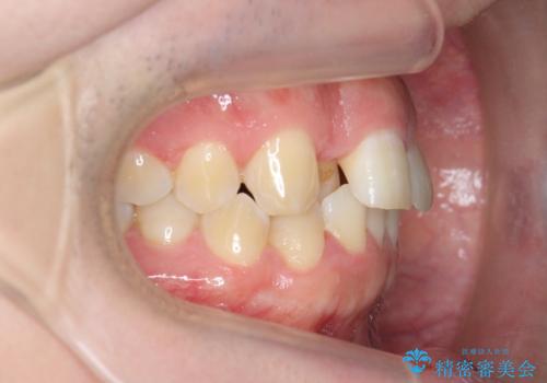 前歯が隠れていて見えない クロスバイトの矯正治療の治療前