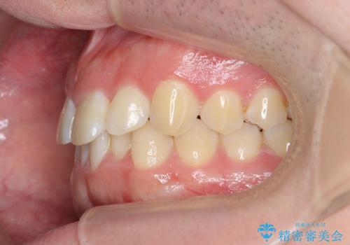 前歯が隠れていて見えない　クロスバイトの矯正治療の治療前