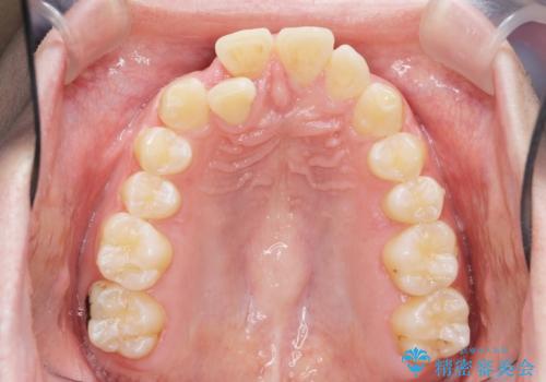 前歯が隠れていて見えない クロスバイトの矯正治療の治療前