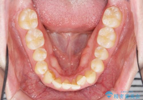 前歯が隠れていて見えない　クロスバイトの矯正治療の治療前