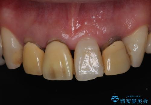 【オールセラミッククラウン】被せ物の色が気になる!の治療前