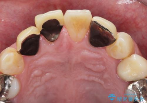 【オールセラミッククラウン】被せ物の色が気になる!の治療前