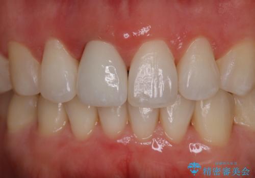 前歯の色が気になる オールセラミッククラウン(SP)の治療後