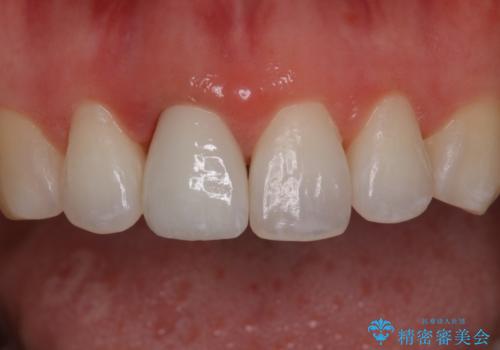 前歯の色が気になる オールセラミッククラウン(SP)の治療後