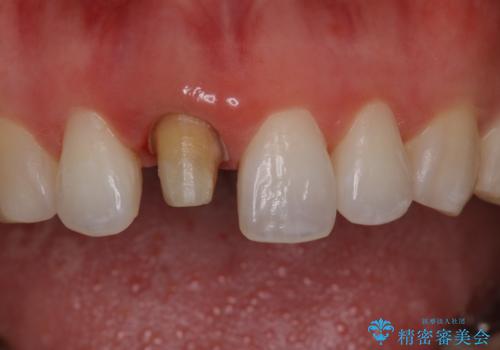 前歯の色が気になる オールセラミッククラウン(SP)の治療中