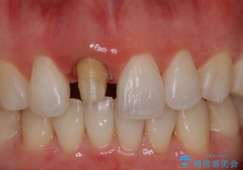 前歯の色が気になる オールセラミッククラウン(SP)の治療中