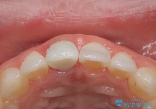 前歯の色が気になる オールセラミッククラウン(SP)の治療後