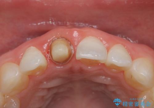 前歯の色が気になる オールセラミッククラウン(SP)の治療中