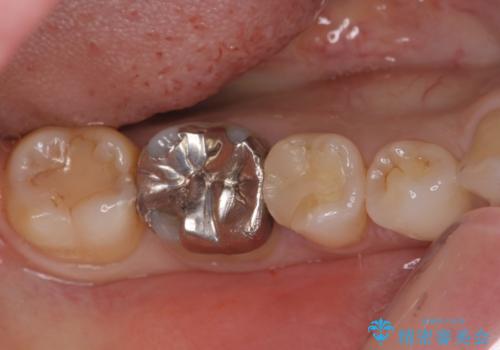 歯と歯の間によくものが詰まる。。セラミック治療の症例 治療前