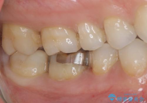 歯と歯の間によくものが詰まる。。セラミック治療の治療前