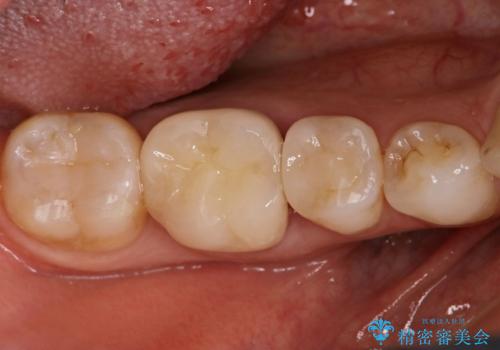 歯と歯の間によくものが詰まる。。セラミック治療の治療後