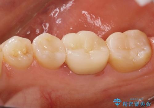 歯と歯の間によくものが詰まる。。セラミック治療の治療後