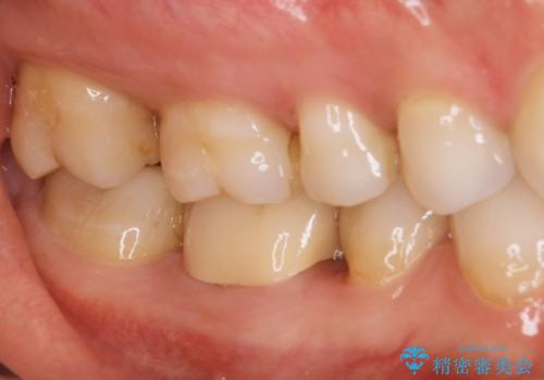 歯と歯の間によくものが詰まる。。セラミック治療の治療後