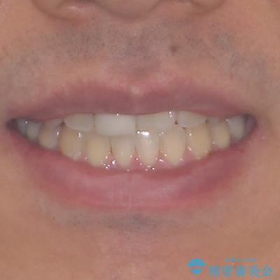 前歯のデコボコとクロスバイトをインビザライン矯正で改善の治療後(顔貌)