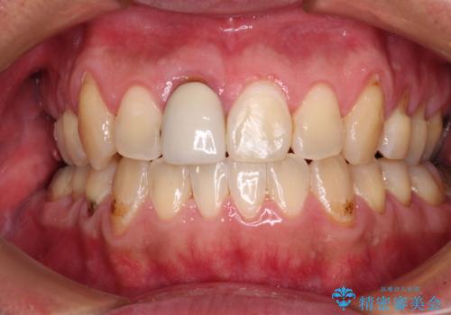 前歯のデコボコとクロスバイトをインビザライン矯正で改善の症例 治療後
