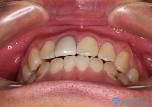 前歯のデコボコとクロスバイトをインビザライン矯正で改善の治療後